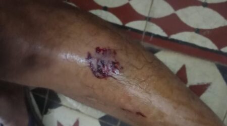 Rottweiler attack: One injured in Assagao