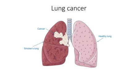 Goa Nears One Lakh Screenings Under AI-Powered Lung Cancer Detection Drive