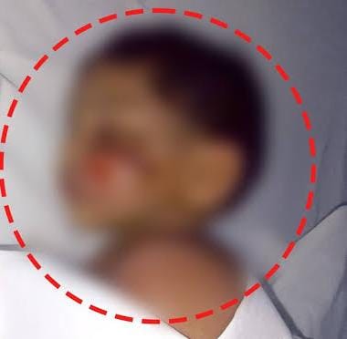 Boy with Severe Injuries Shifted to Shelter Home; Police Probe Adoption, Trafficking Angle