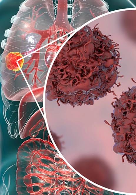 Lung Cancer among women in Goa raises concern